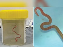 Medizin: Ärzte entfernen lebenden Wurm aus Gehirn einer Australierin
