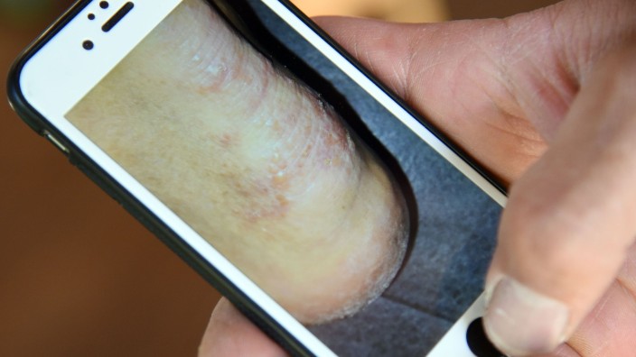 Gesundheit - Biberach an der Riß: Ein Mann zeigt auf einem Smartphone ein Foto seines von Krätze befallenen Fusses. Foto: Henning Kaiser/dpa/Archivbild