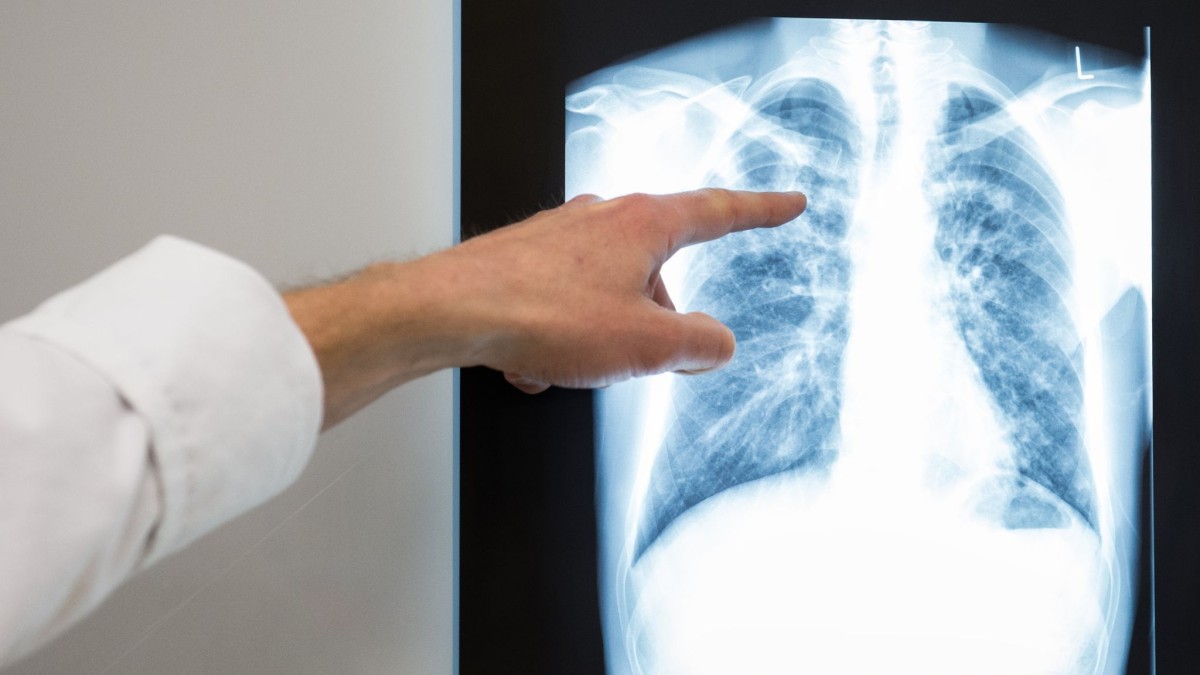 Kesehatan – Sedikit peningkatan jumlah kasus tuberkulosis di Jerman – Kesehatan