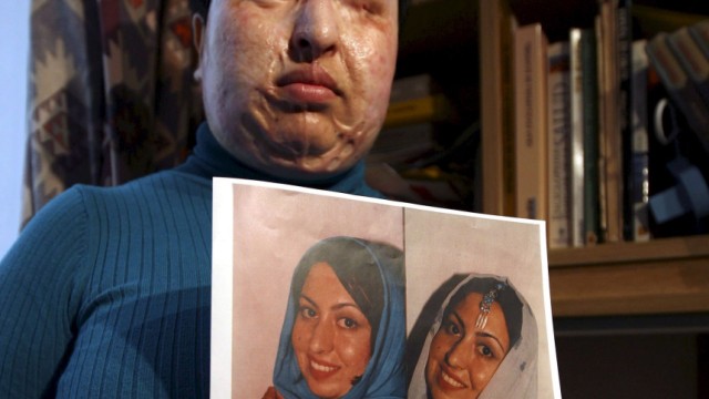 Iranian acid attack victim Ameneh Bahrami