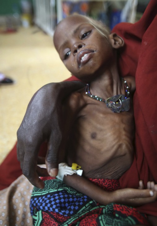 A woman holds her malnourished child on arrival at Banadir hospital in Mogadishu