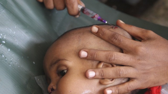 Somali doctors treat a malnourished child at Banadir hospital in Mogadishu