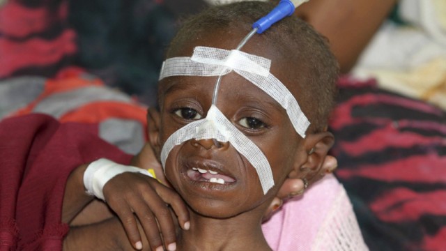 A malnourished child is seen inside a pediatric ward at the Banadir hospital in Somalia's capital Mogadishu
