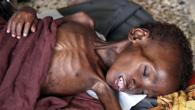 A malnourished child sleeps inside a ward at Banadir hospital in Somalia's capital Mogadishu
