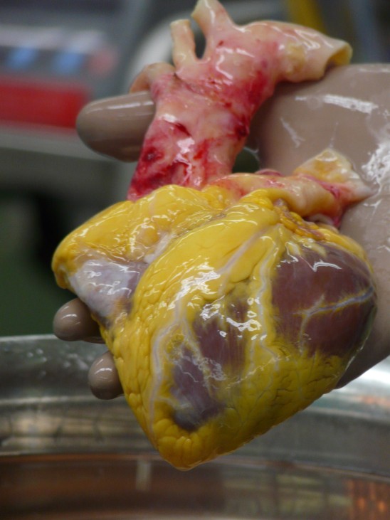 Themenpaket Organspende - Herztransplantation