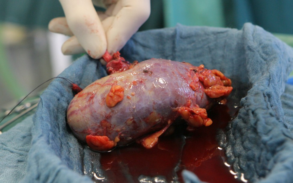 Themenpaket Organspende - Nierentransplantation