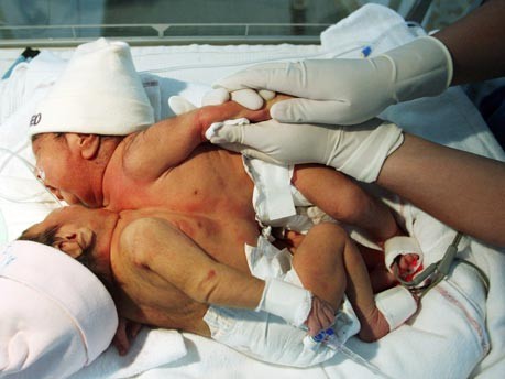 Siamesische Zwillinge in Peru geboren;Reuters