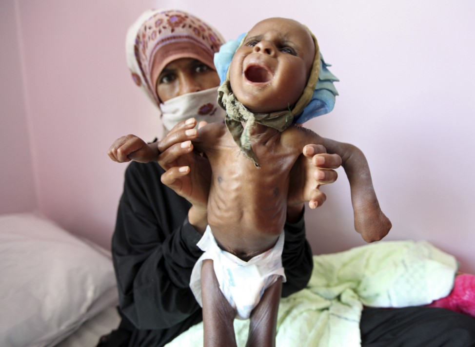 A woman holds her malnourished child at a therapeutic feeding centre in Sanaa
