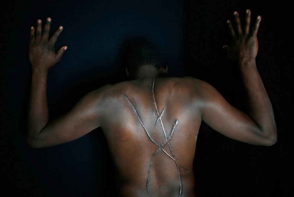 Mekki, a Sudanese migrant, shows scars on his back which he says were inflicted by Greek nationalists in Athens