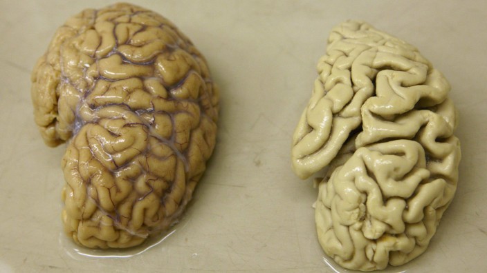 Half a healthy brain is pictured next to half a brain of a person suffering from Alzheimer disease Belle Idee University Hospital in Chene-Bourg