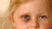 Kindesmisshandlung: Gewalterlebnisse und fehlende Liebe können bei Kindern die Aktivität der Gene im Gehirn verändern.