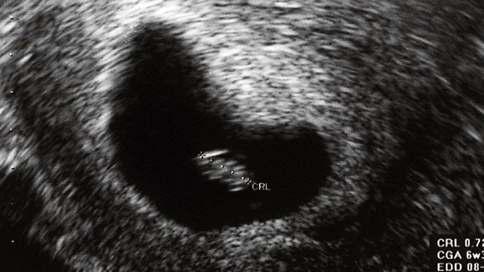 Ultrasound scan of fetus at first trimester PUBLICATIONxINxGERxSUIxAUTxHUNxONLY JFEF000479