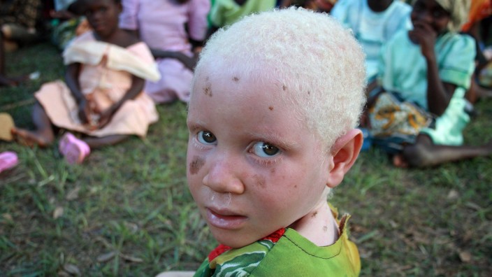 Albino-Kind
