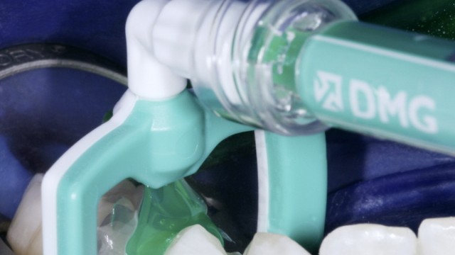 Moderne Medizin in München: Der Zahn wird bei der Behandlung mit einem flüssigen Kunststoff aufgefüllt.