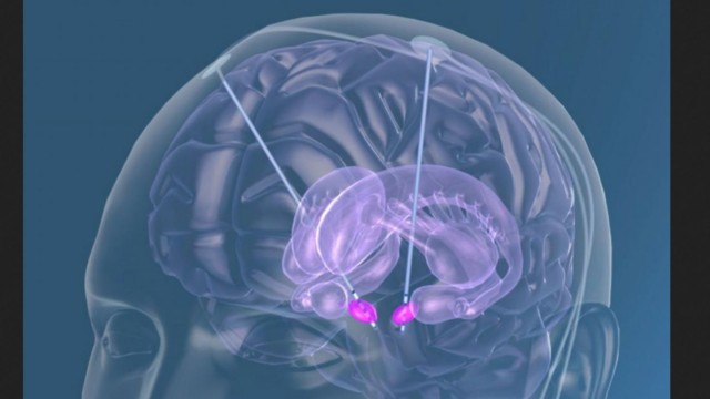 Moderne Medizin in München: Zwei Elektroden werden in einer aufwendigen Operation ins Gehirn geschoben und müssen dort ein gerade mal bohnengroßes Areal treffen.