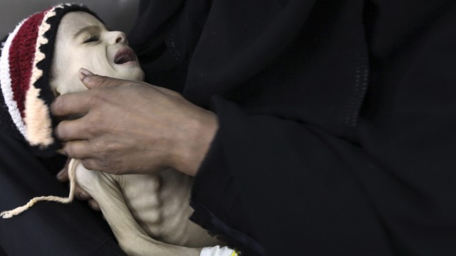 Woman holds her malnourished child at a therapeutic feeding center at al-Sabyeen hospital in Sanaa
