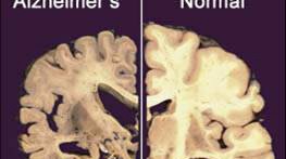Medizin: Ein Gehirn mit (links) und ohne Alzheimer: Forscher wollen neue Techniken im Kampf gegen die Krankheit einsetzen.