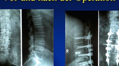 Umstrittener Arzt: Im Internet wirbt der Neurochirurg Abbas Montazem mit Röntgenbildern für seine fragwürdigen Operationen, bei denen er Wirbel künstlich mit Metall versteift.