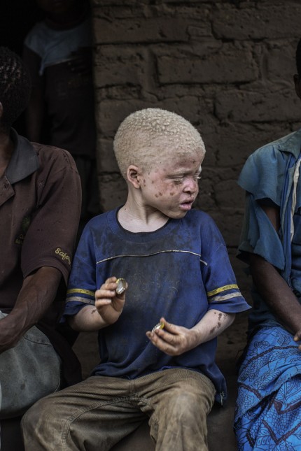 Malawi: Mindestens 65 teils tödliche Angriffe auf Albinos gab es in Malawi seit Anfang vergangenen Jahres.