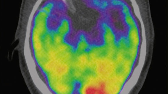 A scan of a brain used in a study associates the brain region called the amygdala, an area linked to stress, to greater risk of heart disease and stroke is seen in an undated image released by The Lancet