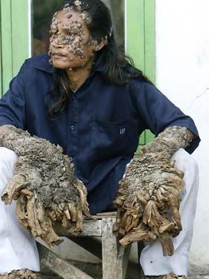 Baum-Mensch in Indonesien