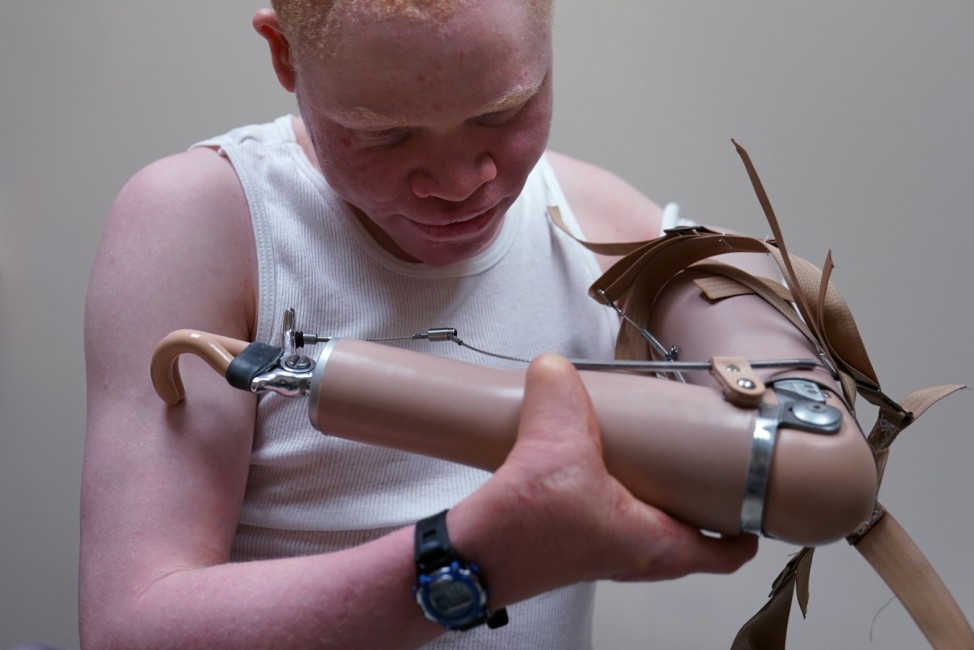 Emmanuel Rutema, a Tanzanian with Albinism who had his arm chopped off in a superstition-driven attack, tries to put on a new prosthetic arm at the Shriners Hospital in Philadelphia