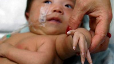 Babys in China: Ein besonders auffälliger Fall war ein Baby, das 2006 mit drei Armen geboren wurde.