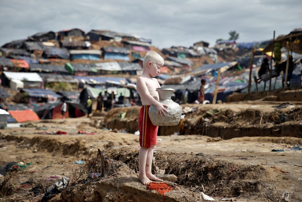 An albino Rohingya refugee poses for a picture in Cox's Bazar, Bangladesh