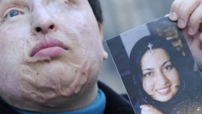 Säureattacke im Iran: Opfer eines Säureangriffs: Ameneh Bahrami.