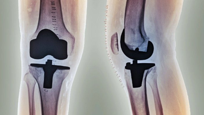 Knie-Operation - Künstliche Kniegelenke
