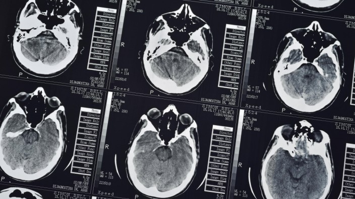 CT Scan eines menschlichen männlichen Gehirns Nahaufnahme *** CT scan of a human male brain Close