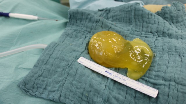 Implant Files: Verformtes Brustimplantat