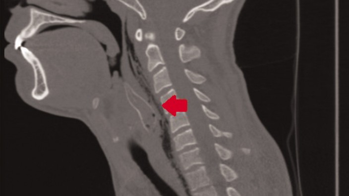 Tierquälerei: Die Röntgenaufnahme des Patienten zeigt, wo der Fisch im Hals stecken geblieben ist