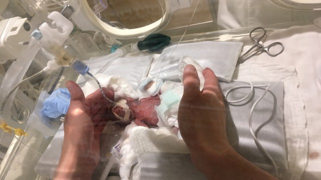 A baby boy weighing 268 grams when born in August 2018, the hospital claims is the smallest baby to survive and be sent home healthy, is seen five days after his birth in Tokyo