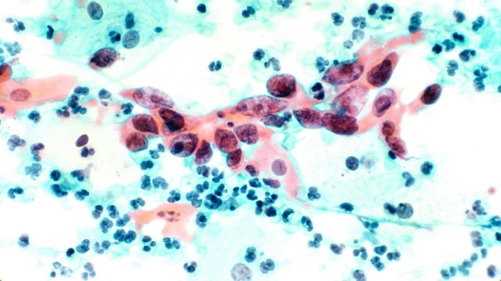 Gynäkologie: Eingefärbte Krebszellen