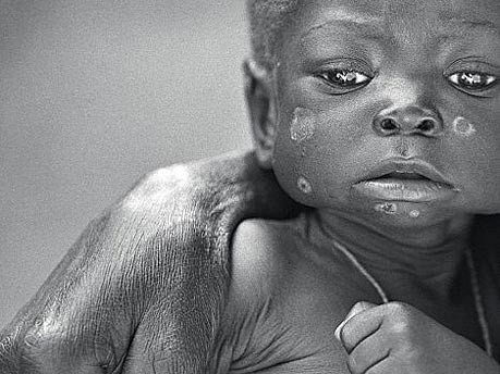 Armut in Afrika, Seuchengefahr, dpa