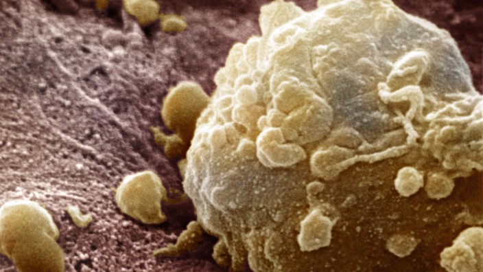 Weltkrebstag: Auf dem Foto sieht es zwar harmlos aus, aber das sogenannte maligne Melanom ist der Name einer bösartigen Tumorerkrankung. Hier ist eine Zelle des Tumors in Vergrößerung zu sehen.