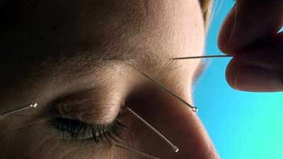 Akupunktur: Akupunktur hilft - allerdings ist es egal, wohin gestochen wird.