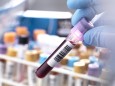 Medical technician preparing a human blood sample for clinical testing model released Symbolfoto property released PUBL