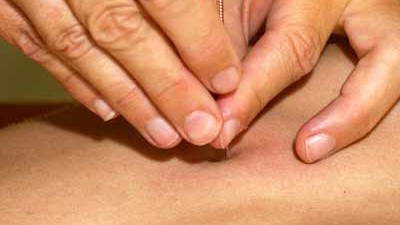 Traditionelle Chinesische Medizin: Bei manchen Leiden ist Akupunktur offenbar hilfreich.