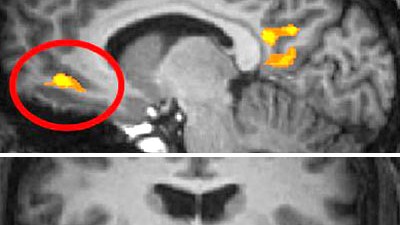 Hirnforschung: Aufnahmen der Hirnaktivität der "Optimismus-Regionen". Oben:  rostraler anteriorer cingulärer Cortex. Unten: Mandelkern.