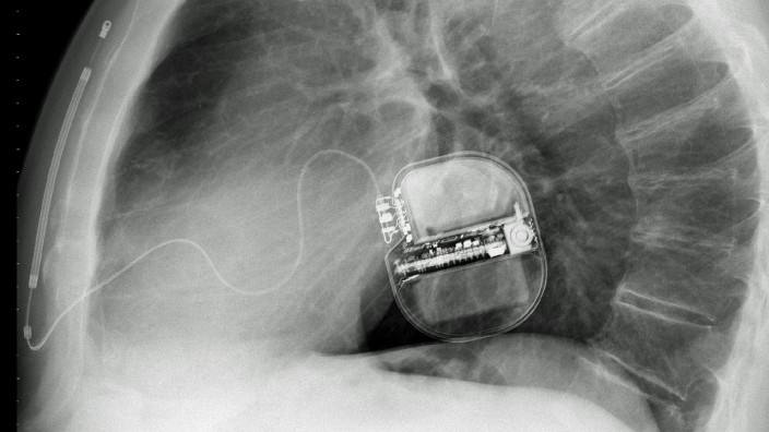 Herzstillstand: Röntgenaufnahme eines Defibrillators.