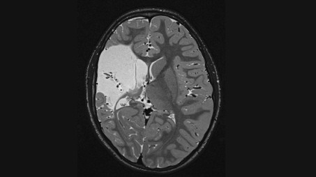 Medizin: Ein MRT-Bild zeigt den massiven Schlaganfall in Carlottas Gehirn.