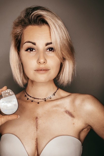 Organspende: Narben, Defibrillator und "fucking" sechs Jahre Kampf: Tamara Schwab erzählt von ihrer Krankengeschichte auf Instagram.