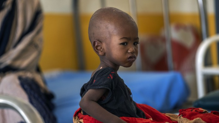 Hungersnot: Ein unterernährtes Kind in einer Klinik in Somalia. Das Land leidet unter der schlimmsten Dürre seit Jahrzehnten.