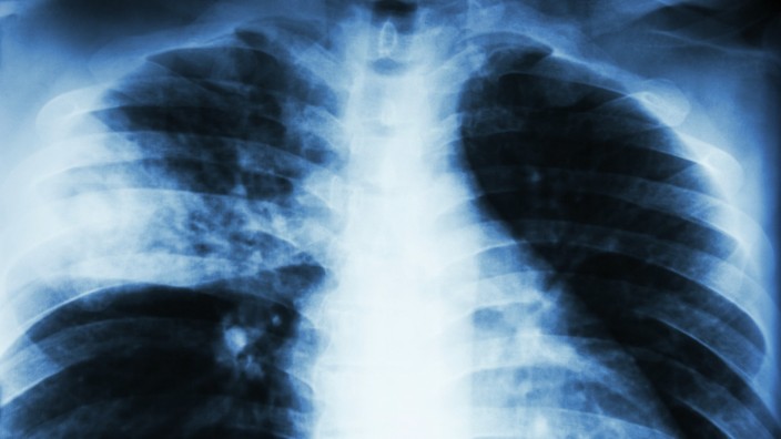 China: Eine Röntgenaufnahme einer Person mit Lungenentzündung (Symbolfoto).