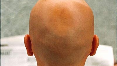 Gerichtsentscheidung: Männer ohne Haupthaar müssen ihre Perücke selbst bezahlen - oder Glatze zeigen.