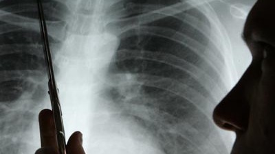 Atemwegserkrankungen Lungenephysem Lungenkrebs Bundesrepublik