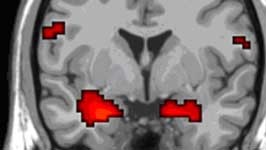 Hirnforschung: Die funktionelle Magnetresonanztomographie macht sichtbar, wie sich die Durchblutung im Gehirn und demnach die Hirnaktivität verändert.