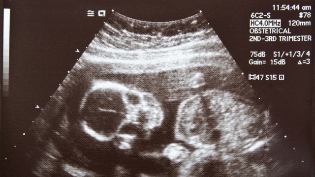 Ultraschall Embryo